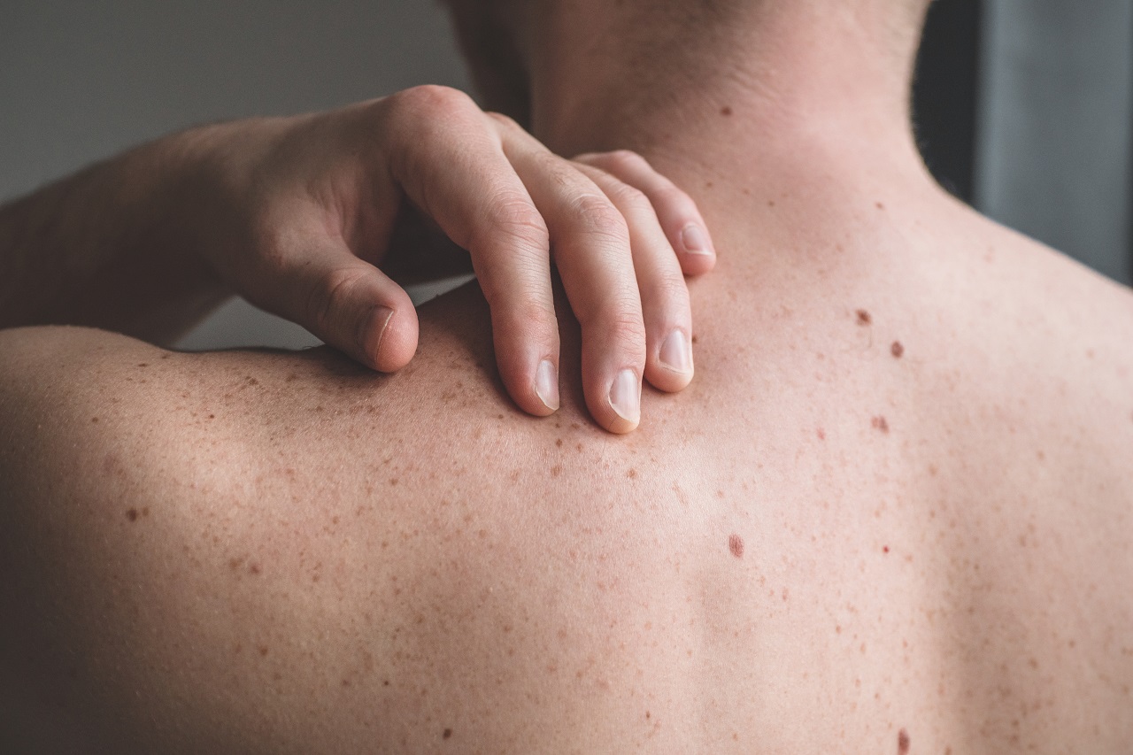 1. Dortmunder Hidradenitis suppurativa-Infoabend